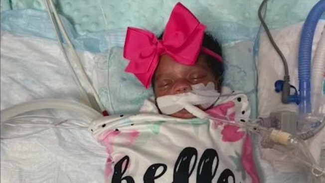 Rare surgery using 3D technology saves child's quality of life