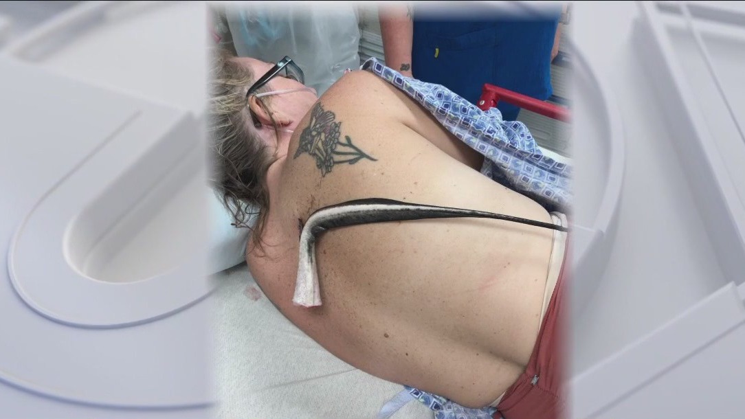 Woman impaled by stingray barb in Florida