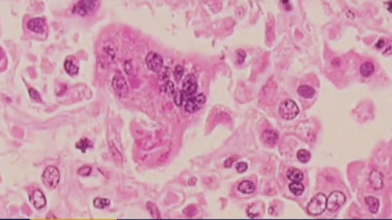 Possible measles cases in San Marcos, San Antonio