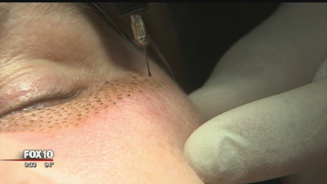 Newly-approved procedure offers advanced way to treat wrinkles, sagging skin and dull skin