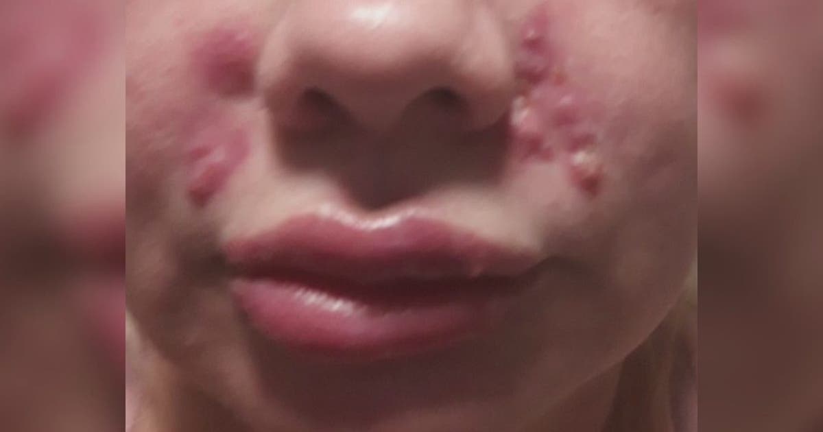More alleged botched lip injection victims come forward | FOX 10 Phoenix