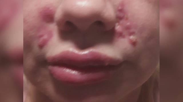 More alleged botched lip injection victims come forward