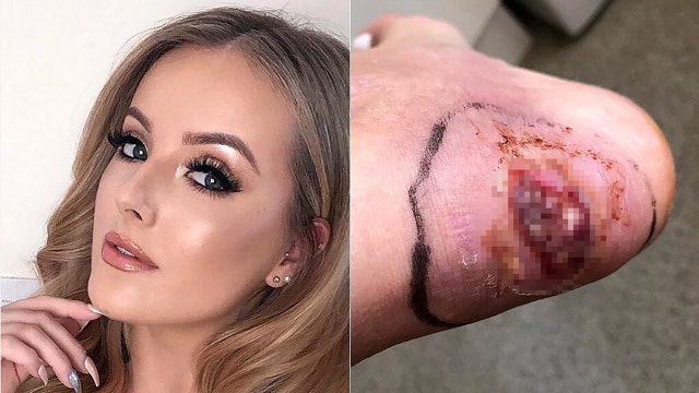 UK woman develops sepsis from blister on heel, claims she 'could have lost her leg'