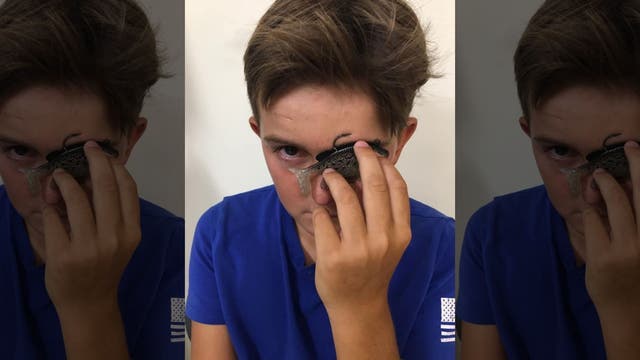 Fishing accident leaves 11-year-old with hook in his eyelid