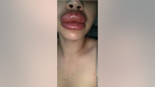 Valley women claim botched lip injections caused severe infection