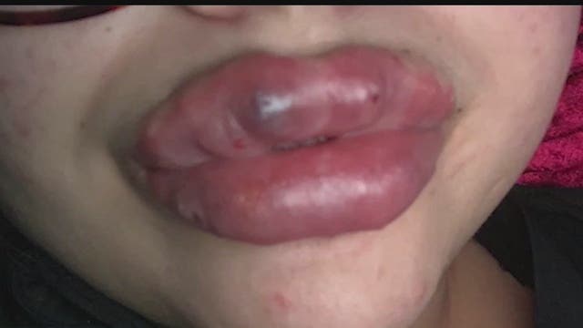 Lip fillers: What to know before you go under the needle
