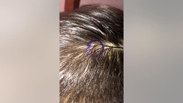 Valley boy needs surgery after freak paintball accident