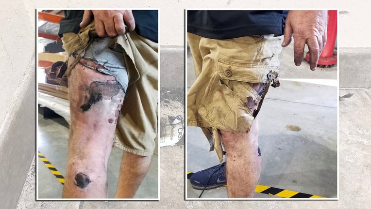 North Port man badly burned in vape pen explosion