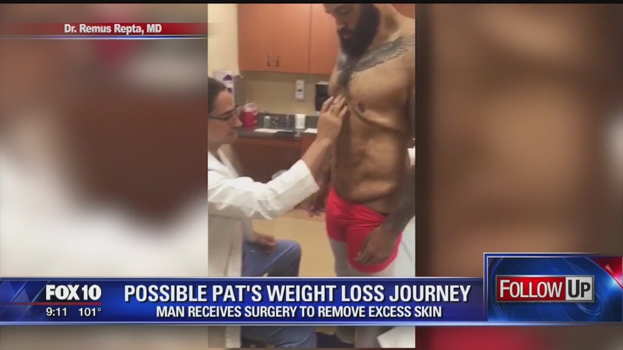 Possible Pat's journey: Man has several feet of skin removed after losing  over 300 pounds