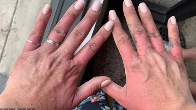 Woman's blistering 'margarita burns' like 'being cooked from the inside out'
