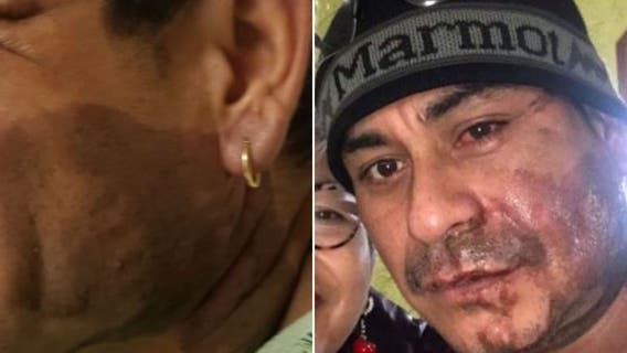 Family says suspect in acid attack is veteran, suffered PTSD