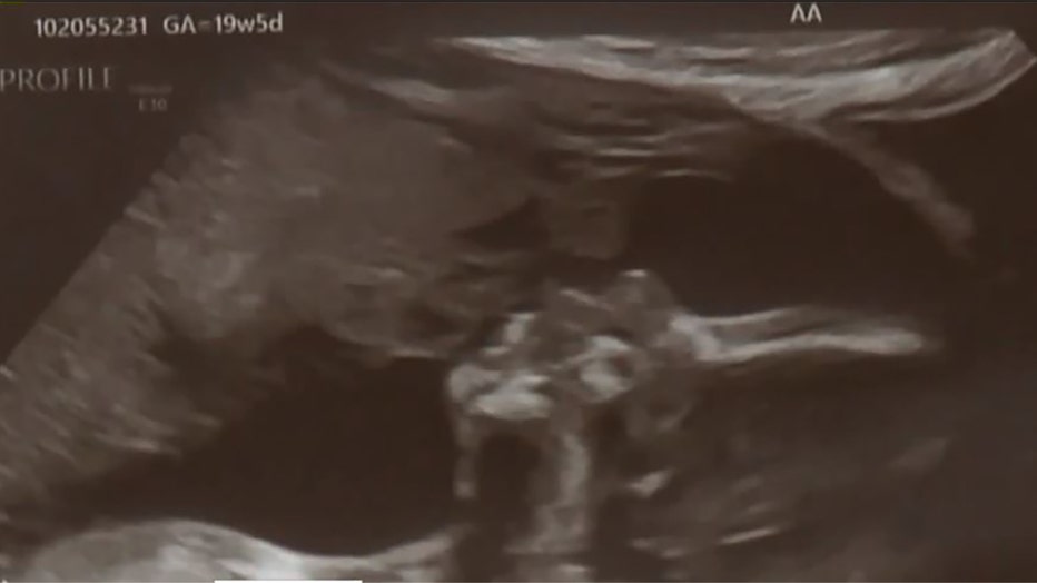 ultrasound-picture-1-THUMB.jpg