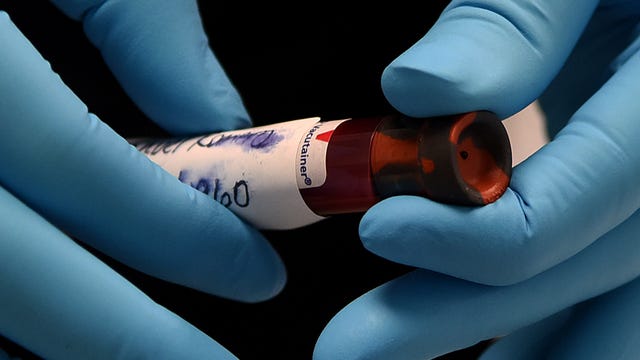 American Medical Association cautions physicians, public about COVID-19 antibody test limitations