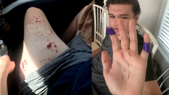 Teen, father fight off shark at North Carolina beach