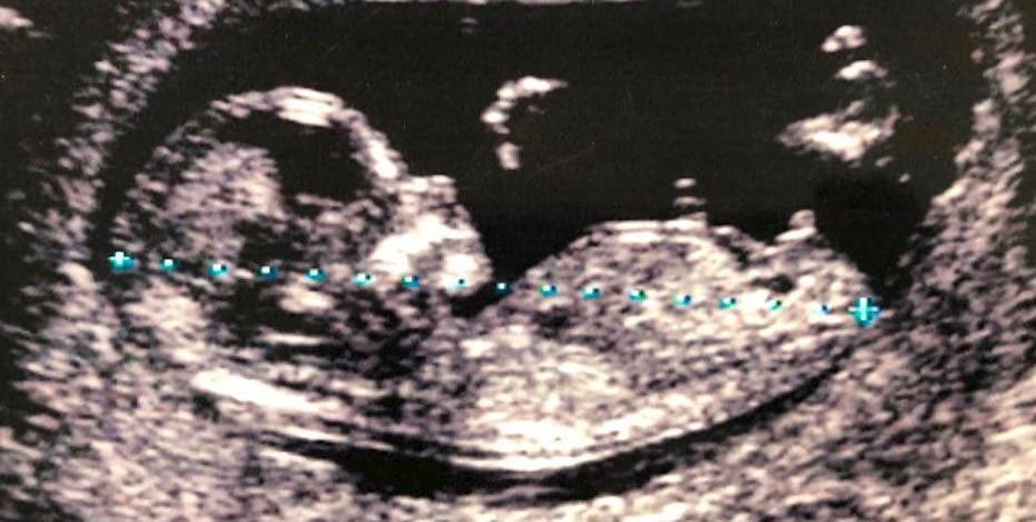 State Senate committee advances proposal that would ban nearly all abortions in Arizona