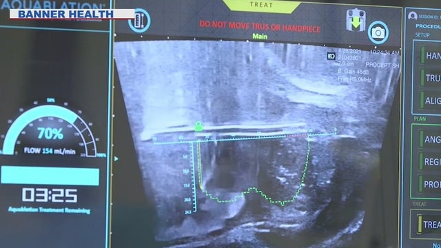 New prostate enlargement procedure at Mesa medical center offers relief, less side effects