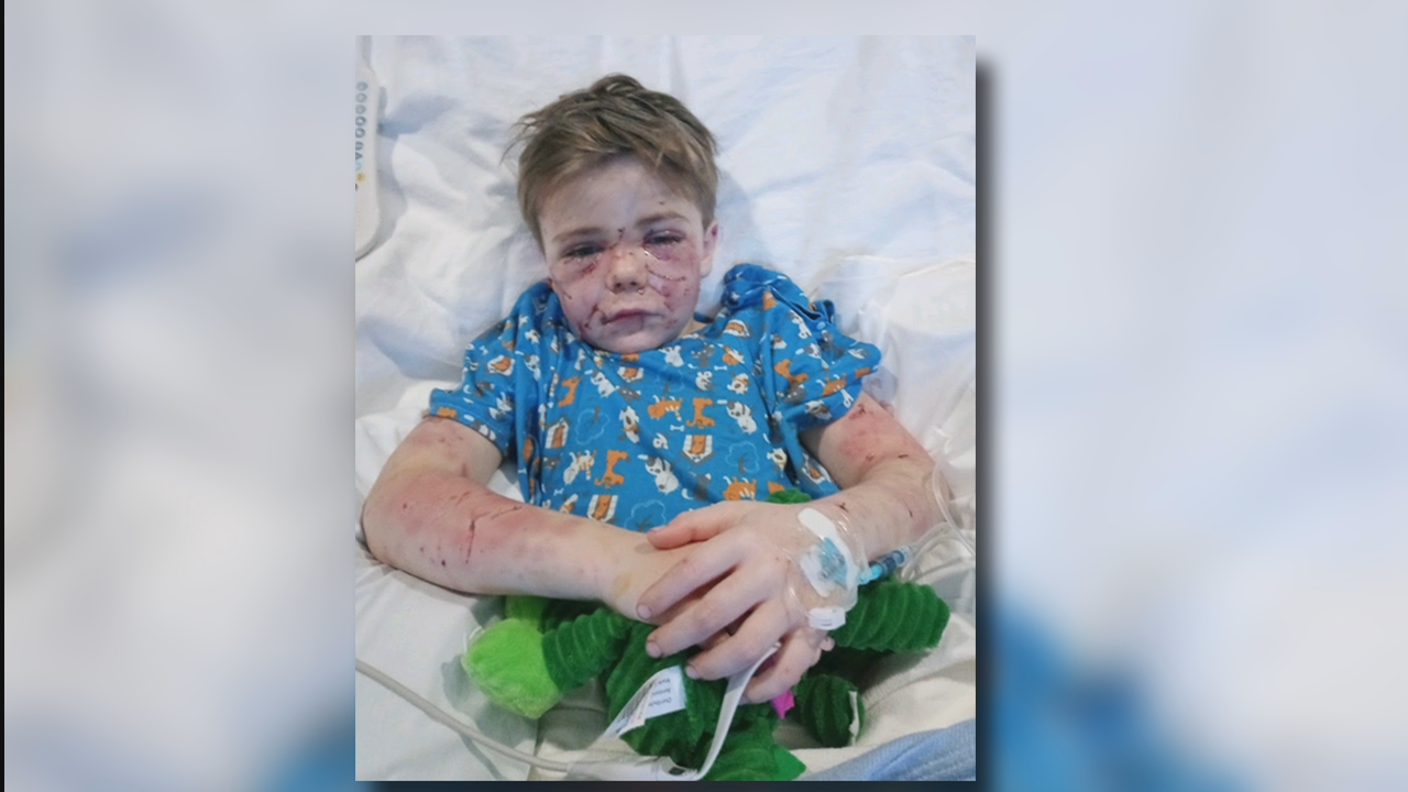 Azle 7-year-old nearly mauled to death by neighbor's dog - Vimarsana News