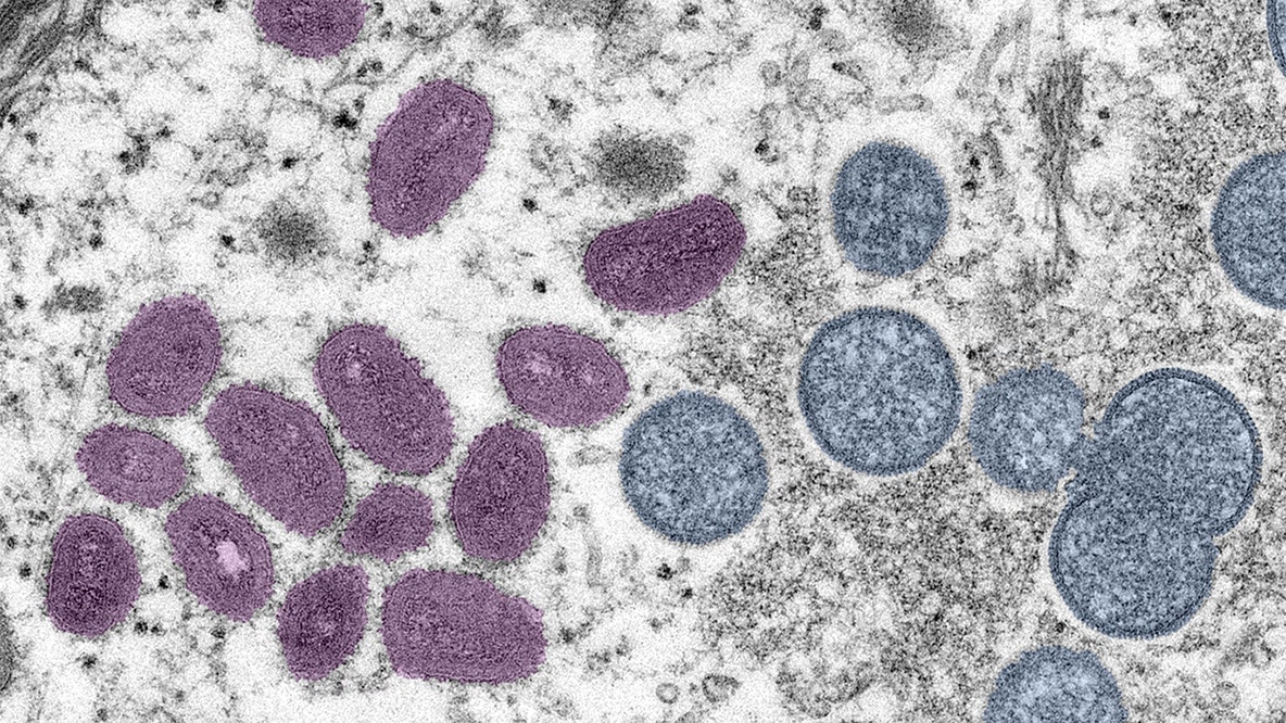 Mpox: Arizona reports case involving a new type of the virus