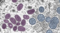 Mpox case involving new virus type confirmed in AZ