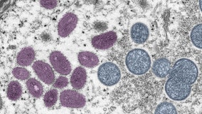 WHO will rename monkeypox virus to counter concerns over stigma, discrimination