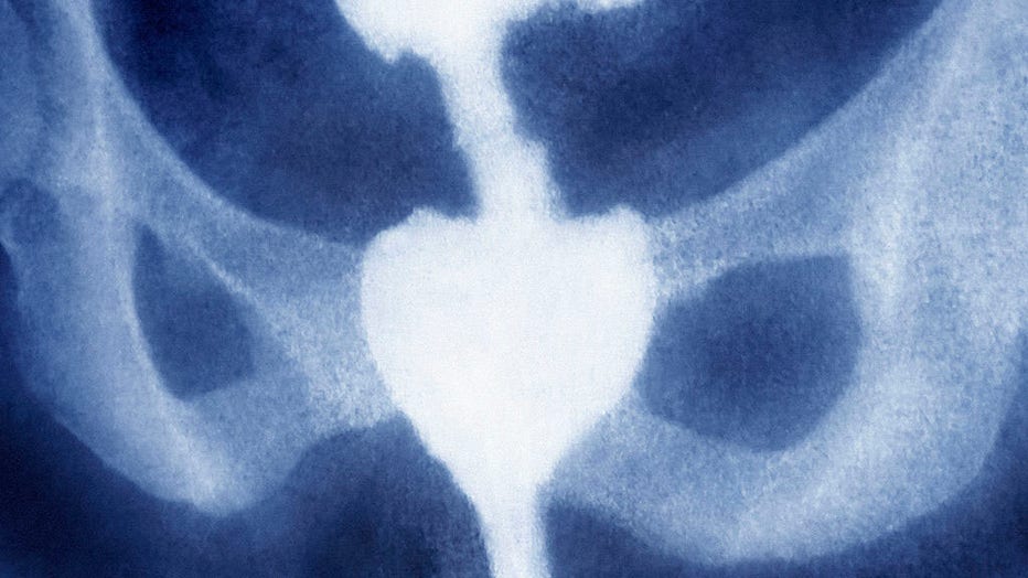 FILE - Rectal carcinoma. Abdominal x-ray in front view. (Photo by BSIP/UIG via Getty Images)