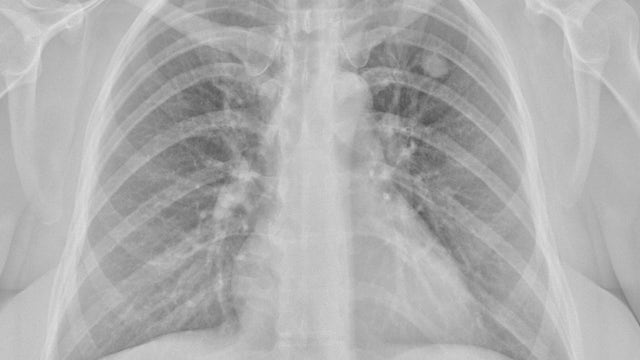 Arizona woman loses lung after ten-year battle with Valley fever symptoms: 'Thankful even to be alive'