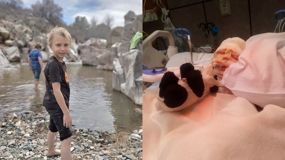 Carson (left), and Carson following the burn incident (right)