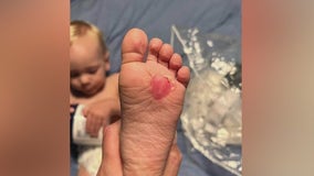 Arizona family sends warning after toddler suffers second-degree burns on feet from hot concrete