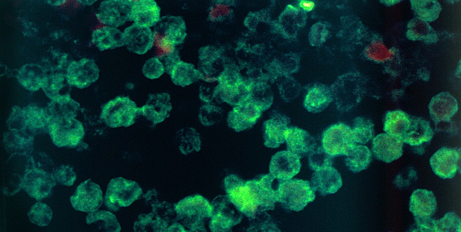 Health officials rule out suspected 'Brain-eating amoeba' case in Arizona: Here's what to know