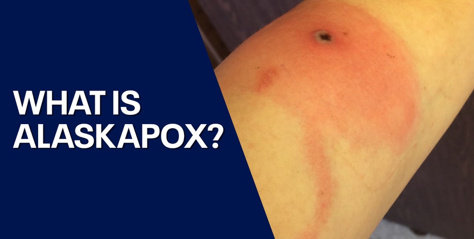 What is Alaskapox? 1st known deadly case reported