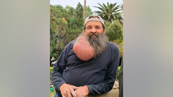 Giant tumor growing for decades removed from neck area of Scottsdale man