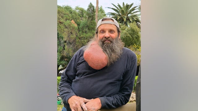 Giant tumor growing for decades removed from neck area of Scottsdale man
