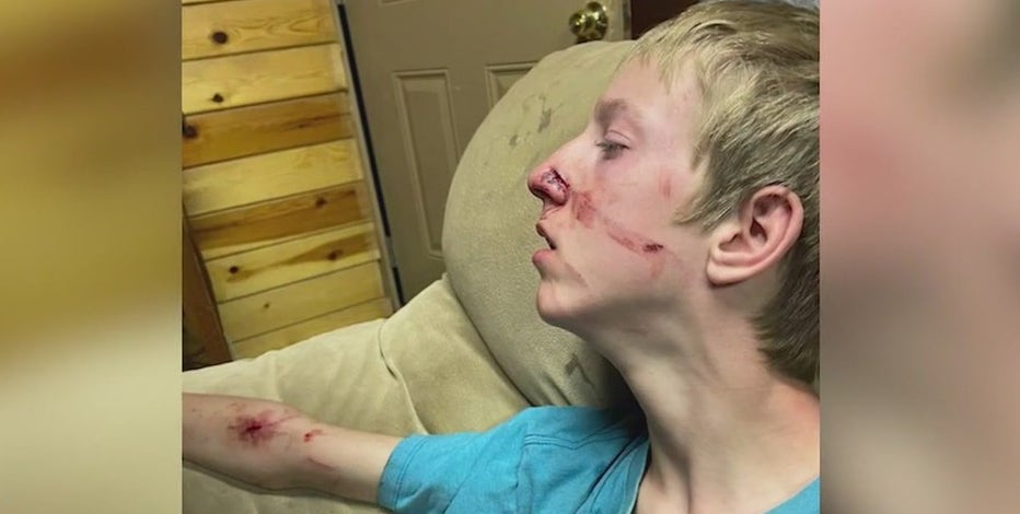 Family comes to rescue of 15-year-old attacked by a bear in Alpine
