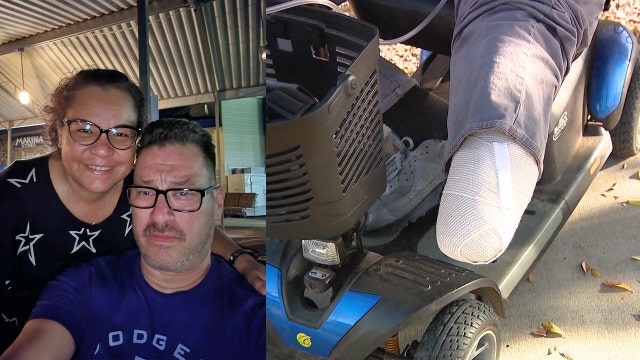 Nurse adjusts to having his foot amputated from bacterial infection as he waits for a prosthetic