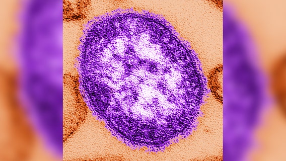 Measles: Maricopa County warns of potential exposure in the East Valley