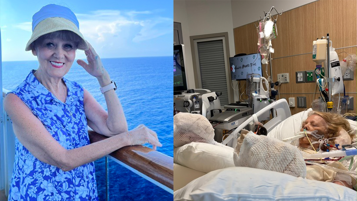 San Tan Valley woman hospitalized with severe burns after falling asleep in sun