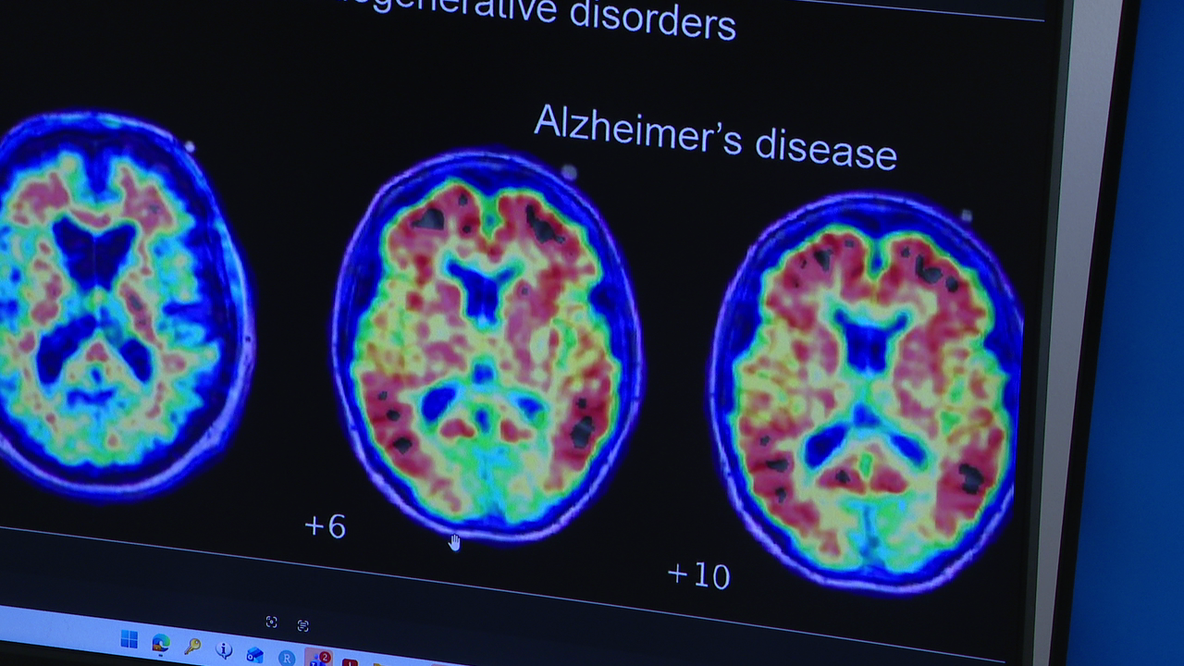 Arizona researchers lead study on breakthrough Alzheimer's disease blood test