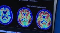 Arizona researchers lead study on breakthrough Alzheimer's disease blood test