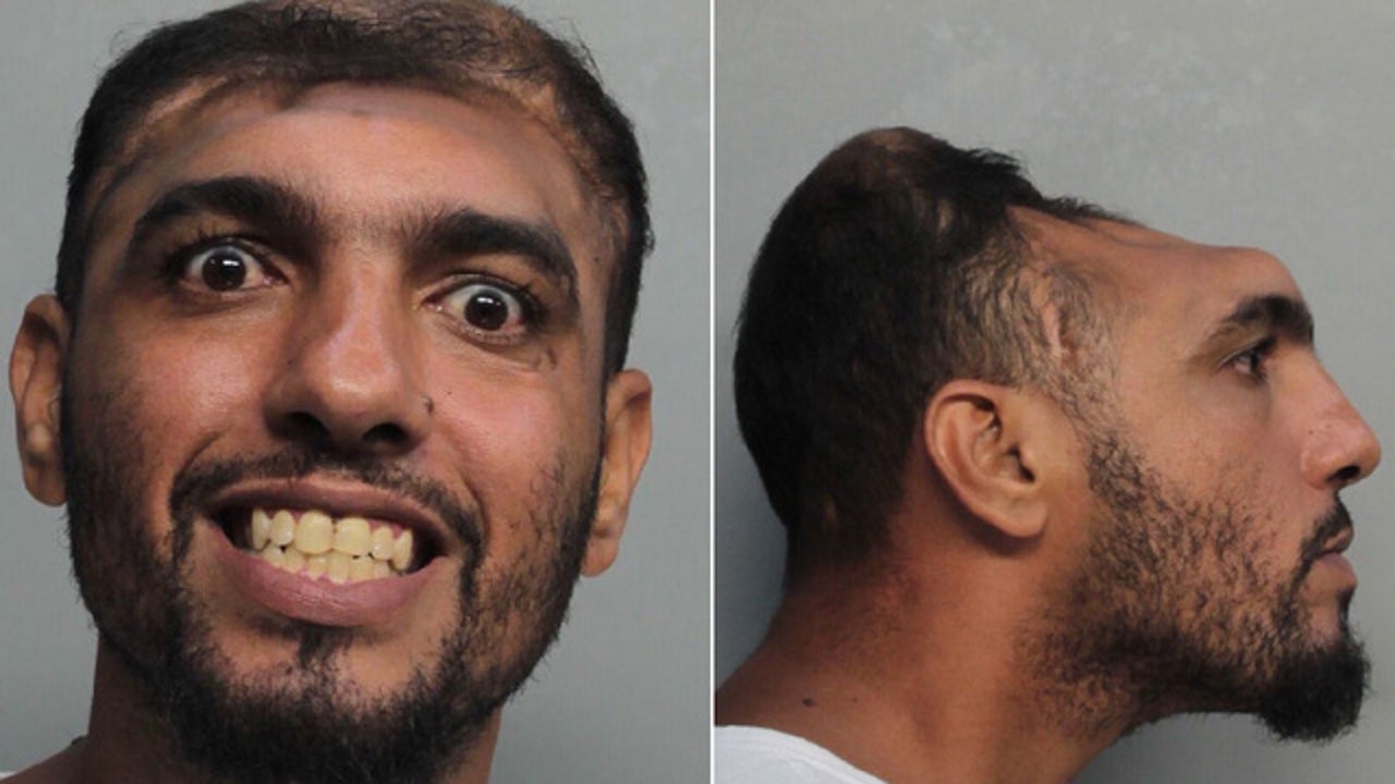 Florida man with half a head arrested for attempted murder
