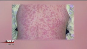 Doctors urge parents to vaccinate children in wake of major measles outbreak