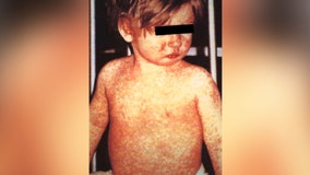 Health officials warn: Get the measles vaccine now
