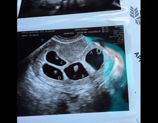 quadruplet ultrasound picture