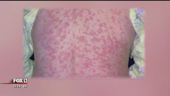 Doctors urge parents to vaccinate children in wake of major measles outbreak