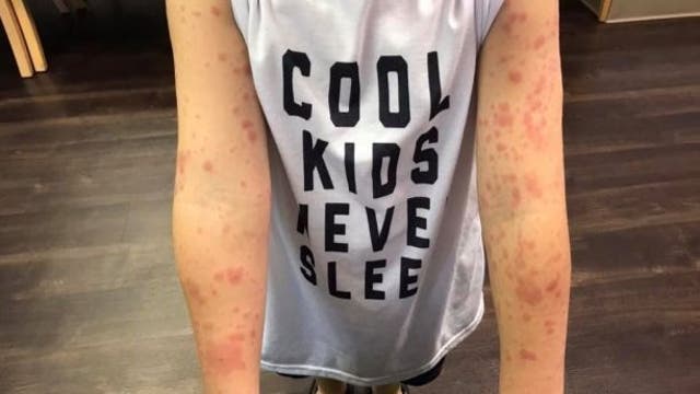 Mom warns others after son, 5, contracts rare disease from tick bite