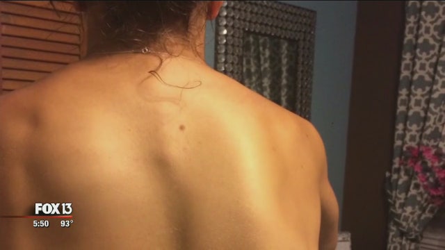 USF dancer didn't back down from scoliosis fight