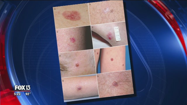 Widow offers warning about amelanotic melanoma