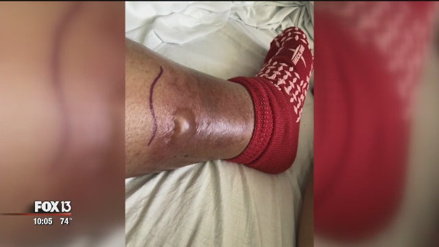 Pinellas County boat captain develops necrotizing fasciitis from vibrio vulnificus