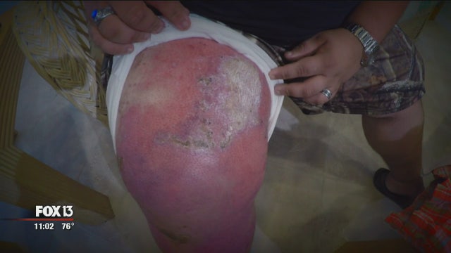 Longboat Key man has grafts after e-cig battery burns