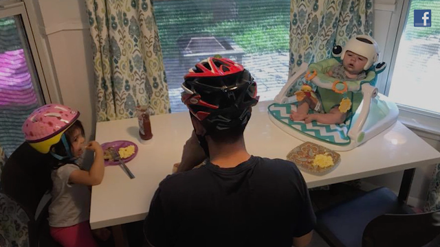 Family wears helmets in show of support for baby with plagiocephaly