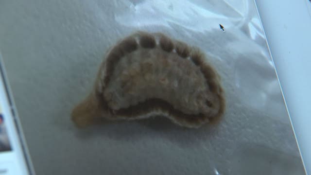 Land O' Lakes teen recovering after puss caterpillar sting